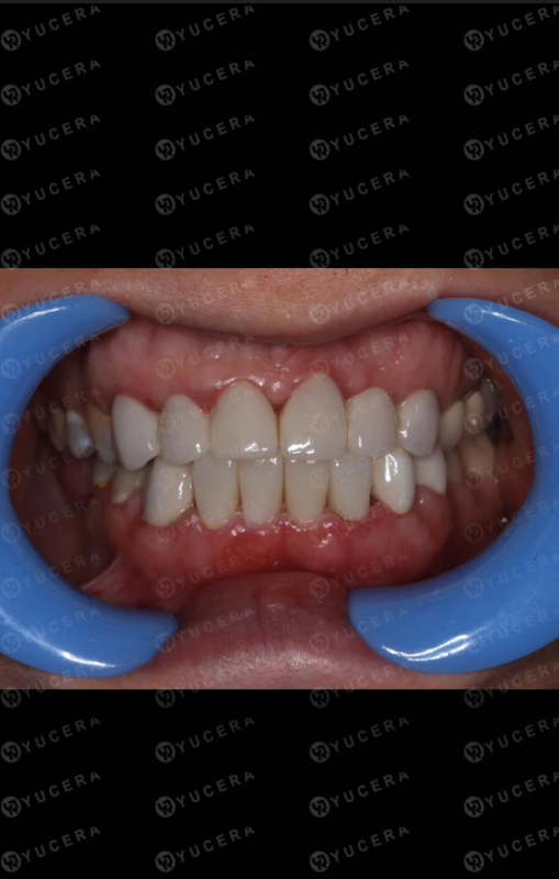 Блоки из стоматологического циркония Yucera ST color - Ваш надежный выбор для реалистичных стоматологических реставраций